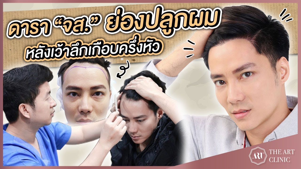 ปลูกผม FUE : อัพเดตปลูกผมคุณจอห์นสัน เทวินธวิ์ 1 ปี