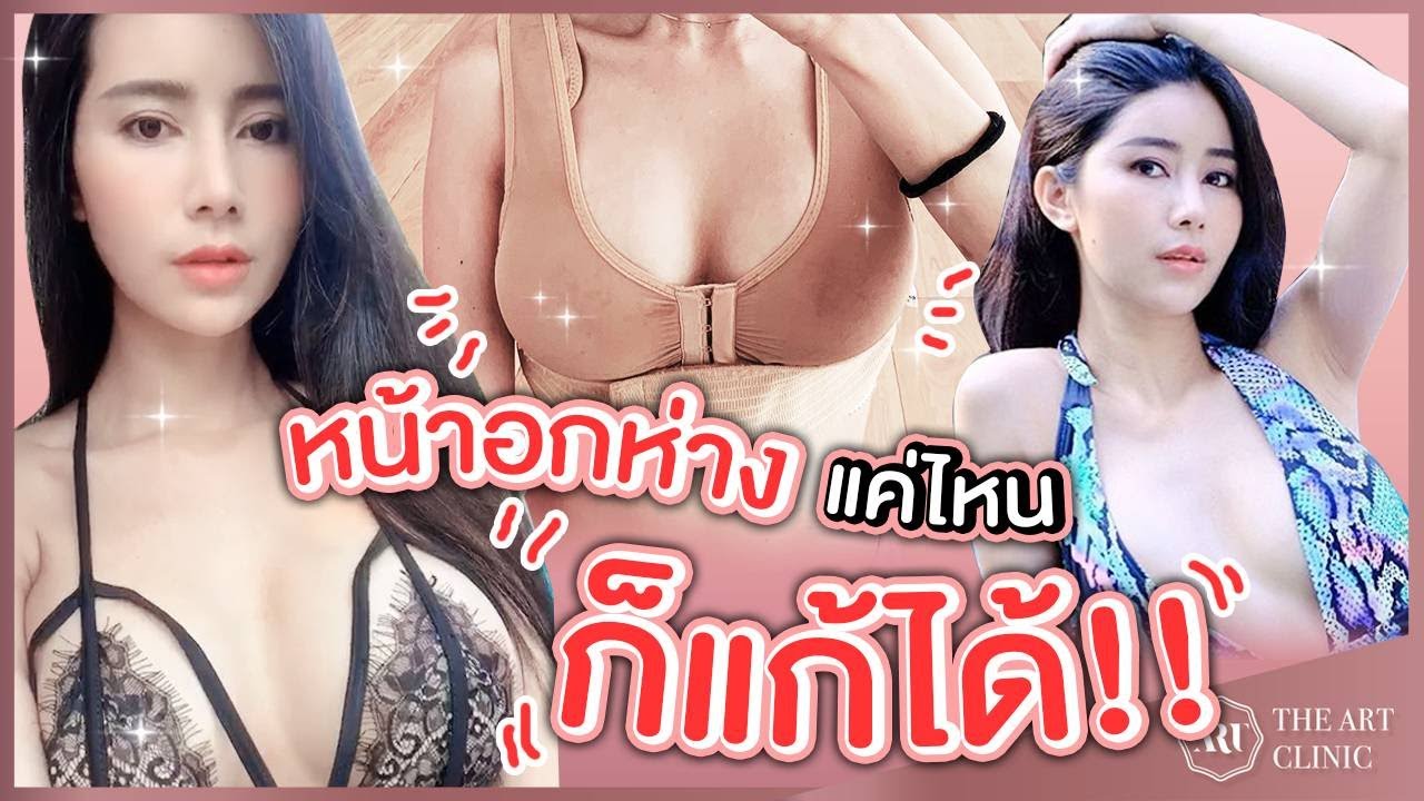The Art : รับแก้หน้าอกห่าง ทรงผิดรูป มีพังผืด ให้คุณกลับมาสวยเซ็กซี่มั่นใจอีกครั้ง