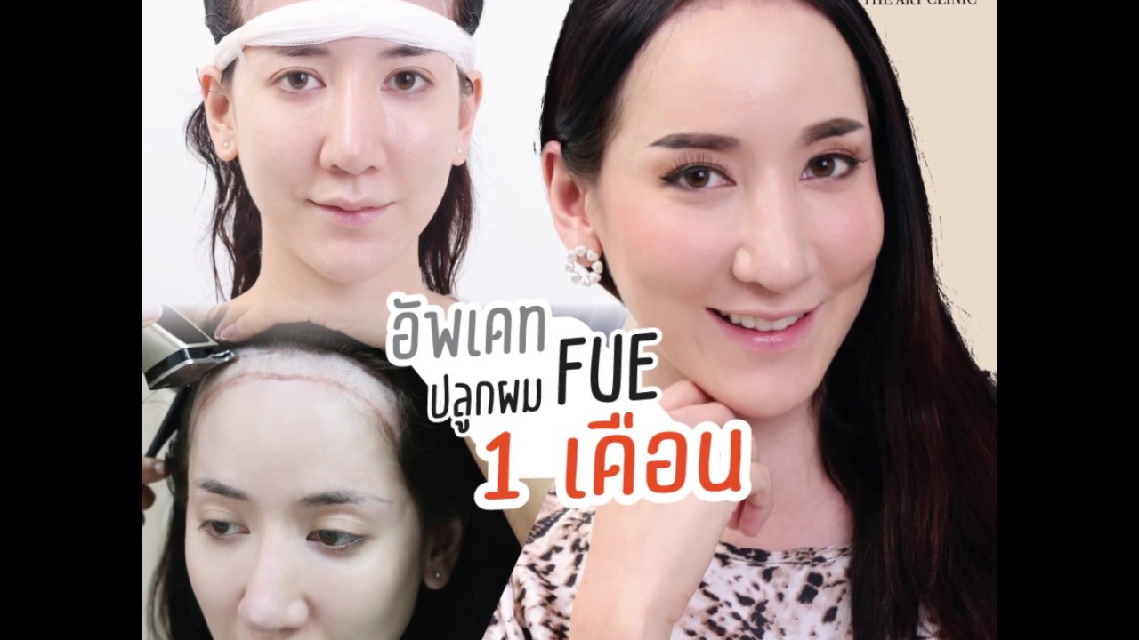 ปลูกผม FUE : อัพเดตปลูกผมคุณกอหญ้า 1 เดือน