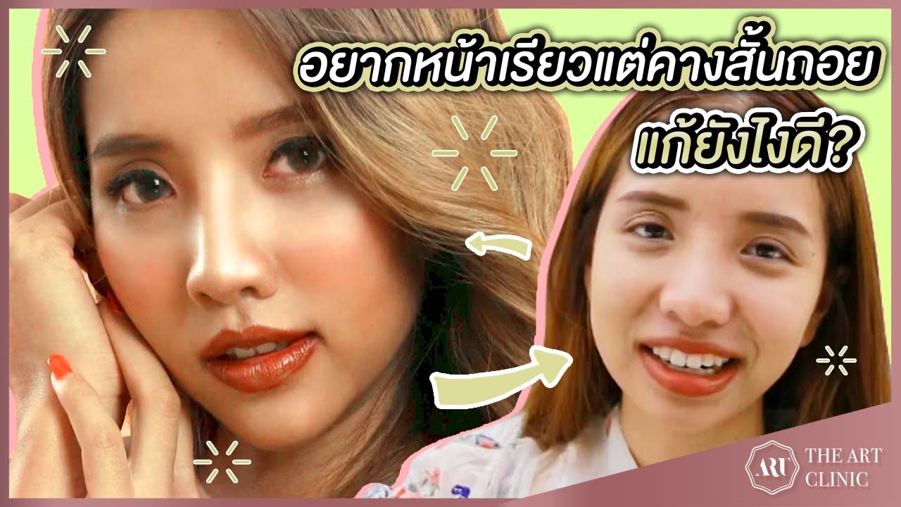 Vlog Review : เสริมคางปรับโครงหน้ากับคุณหมออาท The Art
