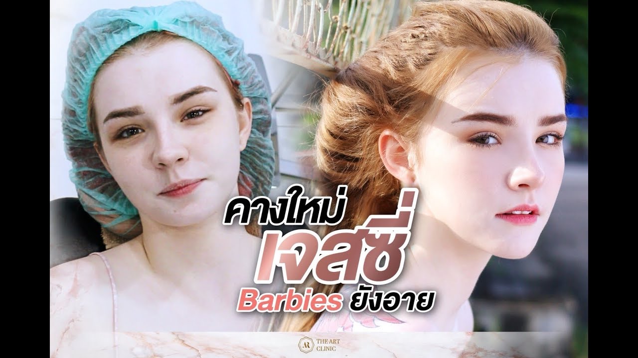 เสริมคาง : คางใหม่เจสซี่ บาร์บี้ยังอาย  The Art