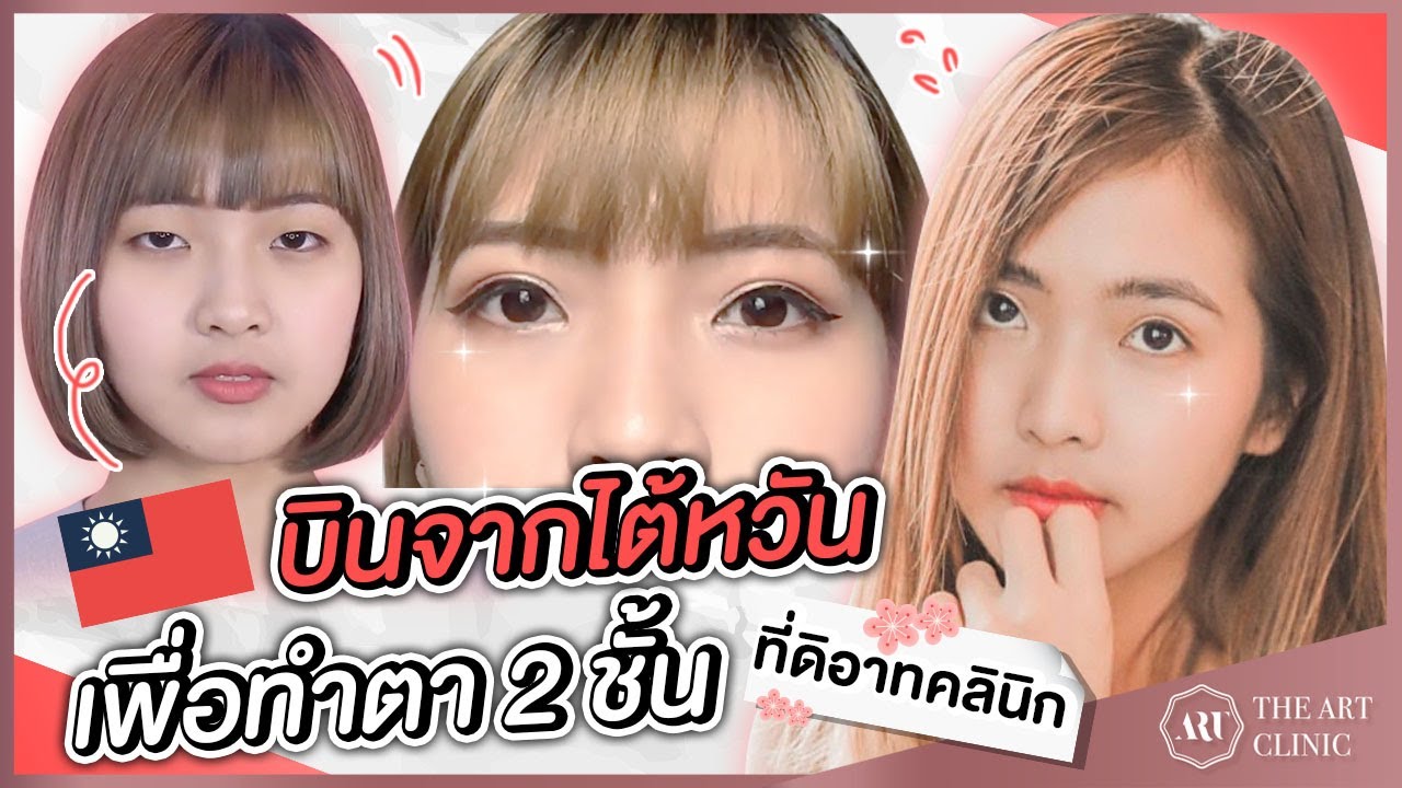 SURGERY VLOG : น้องตันหยง (tanyonggggg) กับการทำตา 2 ชั้น ที่ The Art