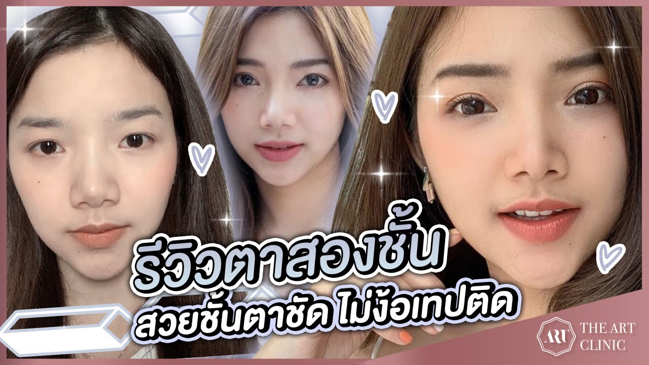 SURGERY VLOG : น้องแนน (nnann.k)  กับการทำตา 2 ชั้น ที่ The Art