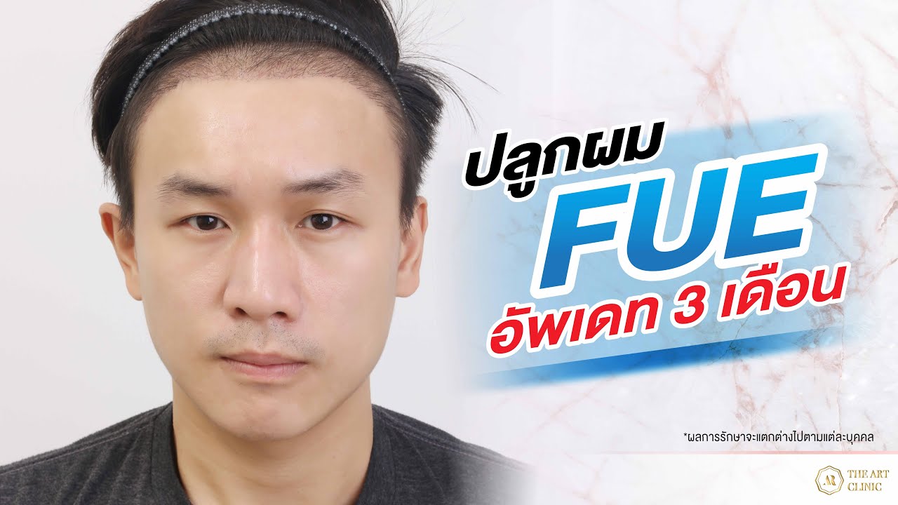 ปลูกผม FUE ไม่ต้องผ่าตัด  The Art