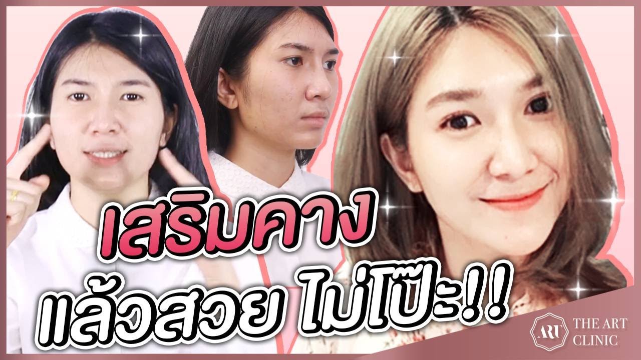 VLOG : เสริมคาง เปลี่ยนสาวหน้าแมน ให้ดูหวาน ที่ The Art