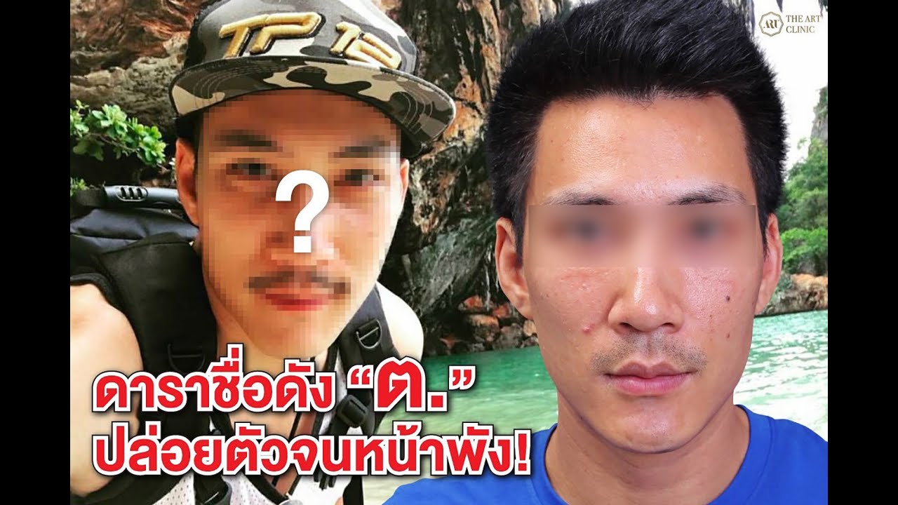 ดาราชื่อดังอักษรย่อ ต. ผิวหน้าพัง เพราะขาดการดูแล!!
