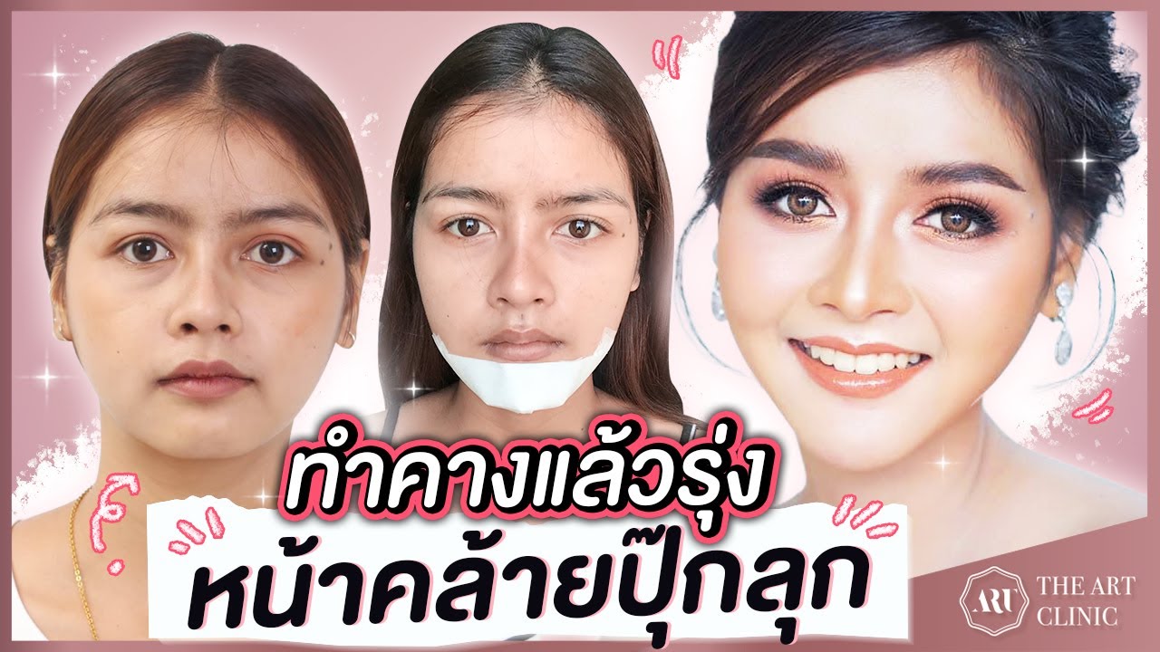 VLOG เสริมคาง : เพื่อนล้อเป็นหมาหน้าสั้น เลยมาทำคางที่ The Art