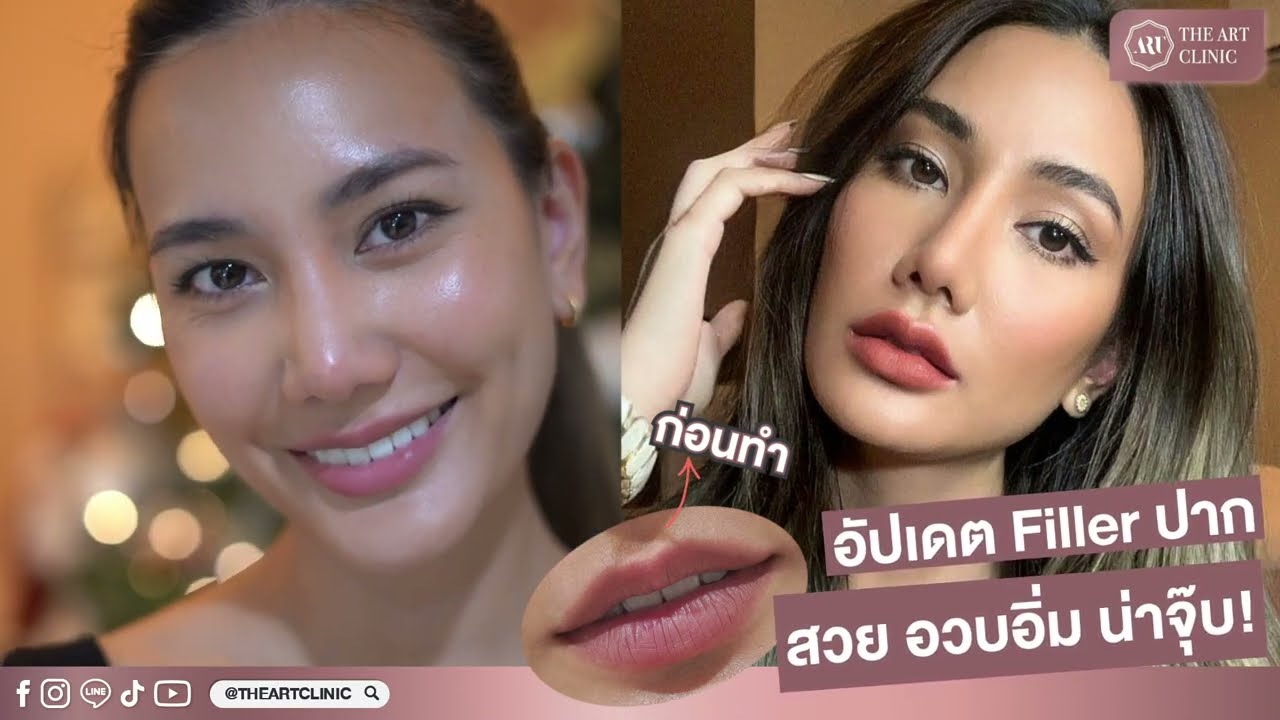 Filler ปากสวย สไตล์นางงาม #หมอบอลดิอาท 💉💋