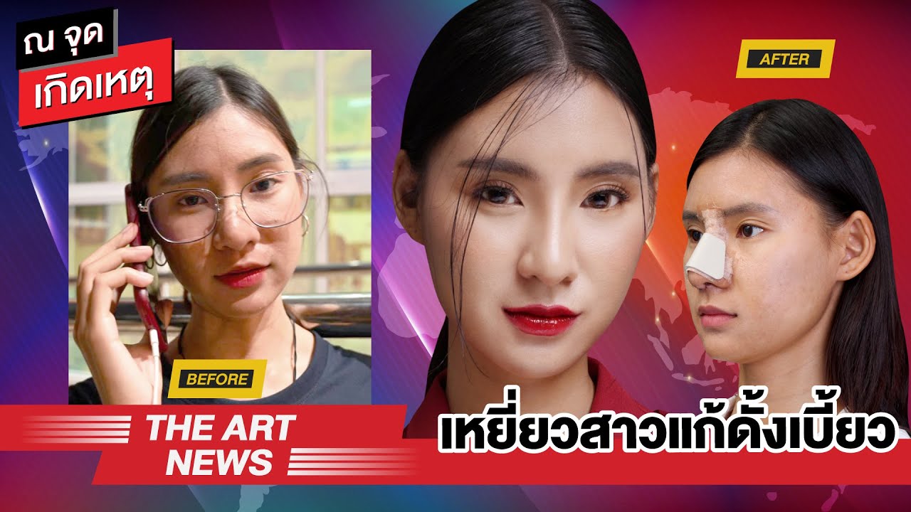 รีวิวจมูก OPEN : ชมความปังของคุณนัทตี้ ข่าวสดจุดเกิดเหตุ หลังมาแก้จมูกเบี้ยว ที่ The Art