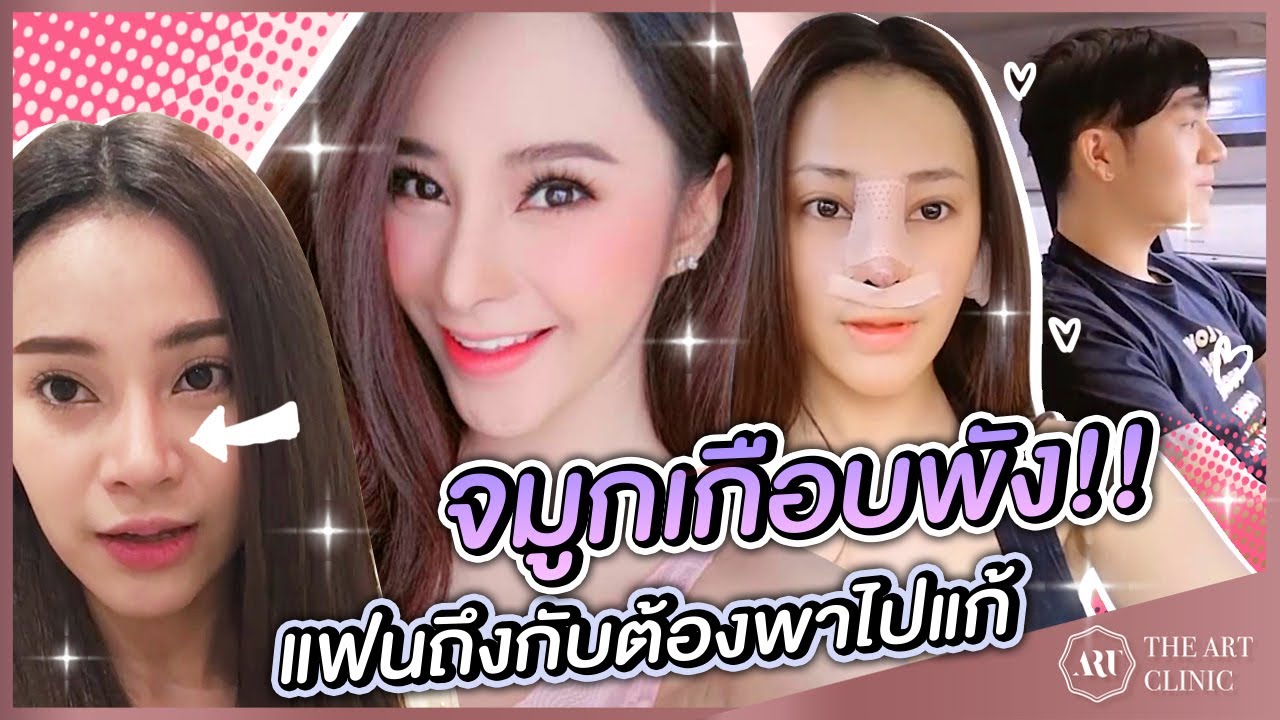 VLOG : แก้จมูก OPEN แก้จมูก Open จากเบี้ยวเอียง เป็นสวยโด่งพุ่งสโลป