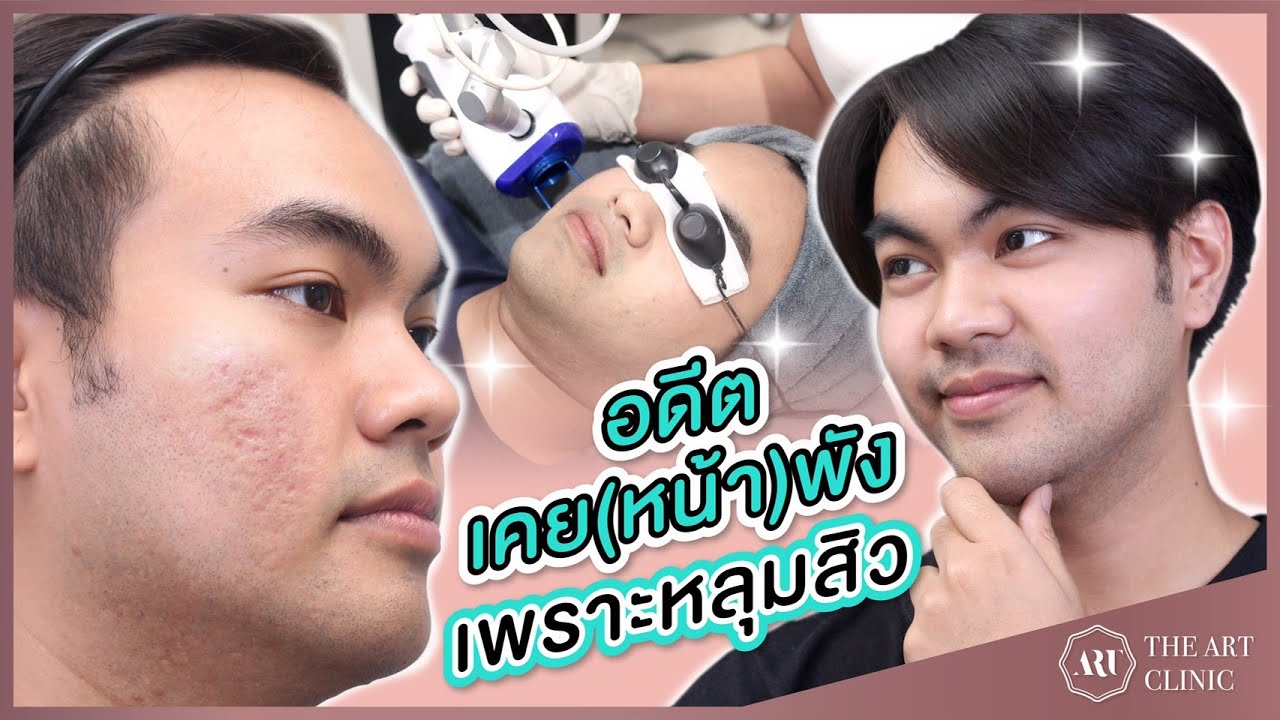 ใครเคยเป็นสิว แล้วทิ้งร่องรอยไว้ อยากรักษาให้หาย #ต้องดูคลิปนี้นะคะ
