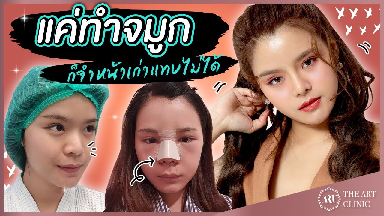 เสริมจมูก Open : โด่งพุ่งหยดน้ำ จำหน้าเก่าแทบไม่ได้เลย
