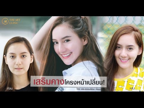 รีวิว เสริมคาง น้องเจนี่ The Art
