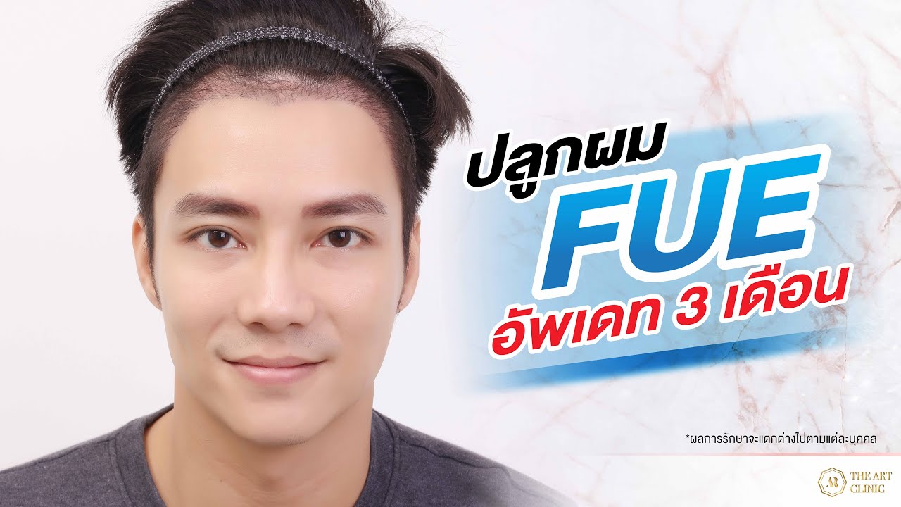 ปลูกผม FUE เปลี่ยนลุคใหม่ได้ใน 3 เดือน The Art