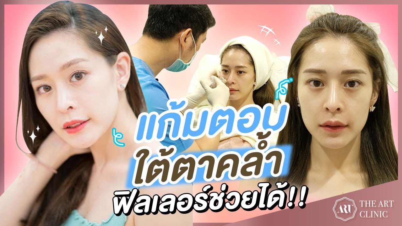 ใต้ตาคล้ำ ขมับตอบ แก้มตอบ ให้หน้าเด็กแบบไม่ต้องผ่าตัด ด้วย Filler