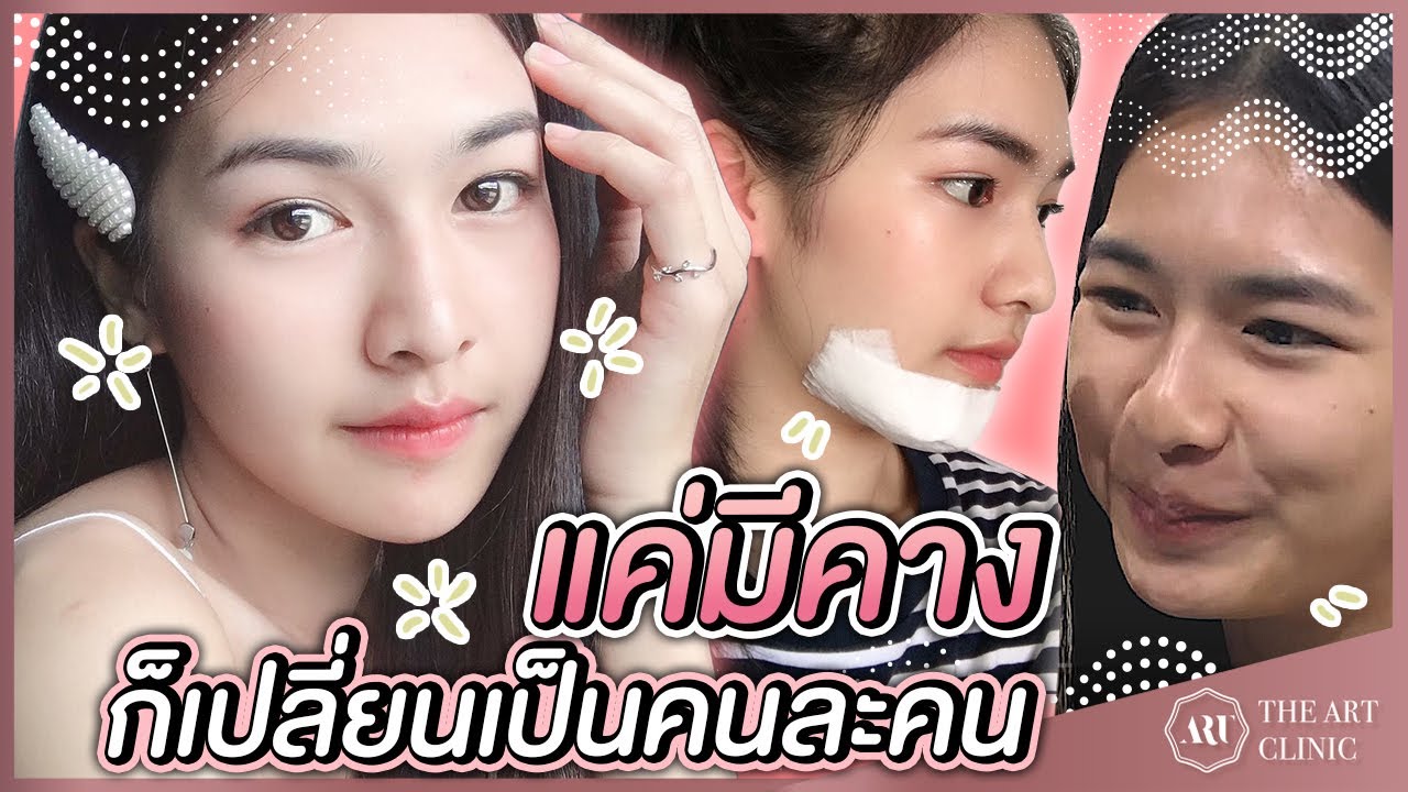 VLOG เสริมคาง : สาวคางสั้นหน้ากลม อยากหน้าสวยต้องดู :The Art
