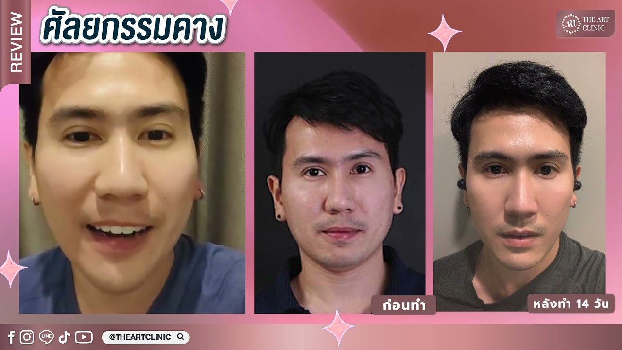 รีวิวเสริมคางผู้ชาย  แค่มีคางหน้าก็เปลี่ยน ที่ The Art
