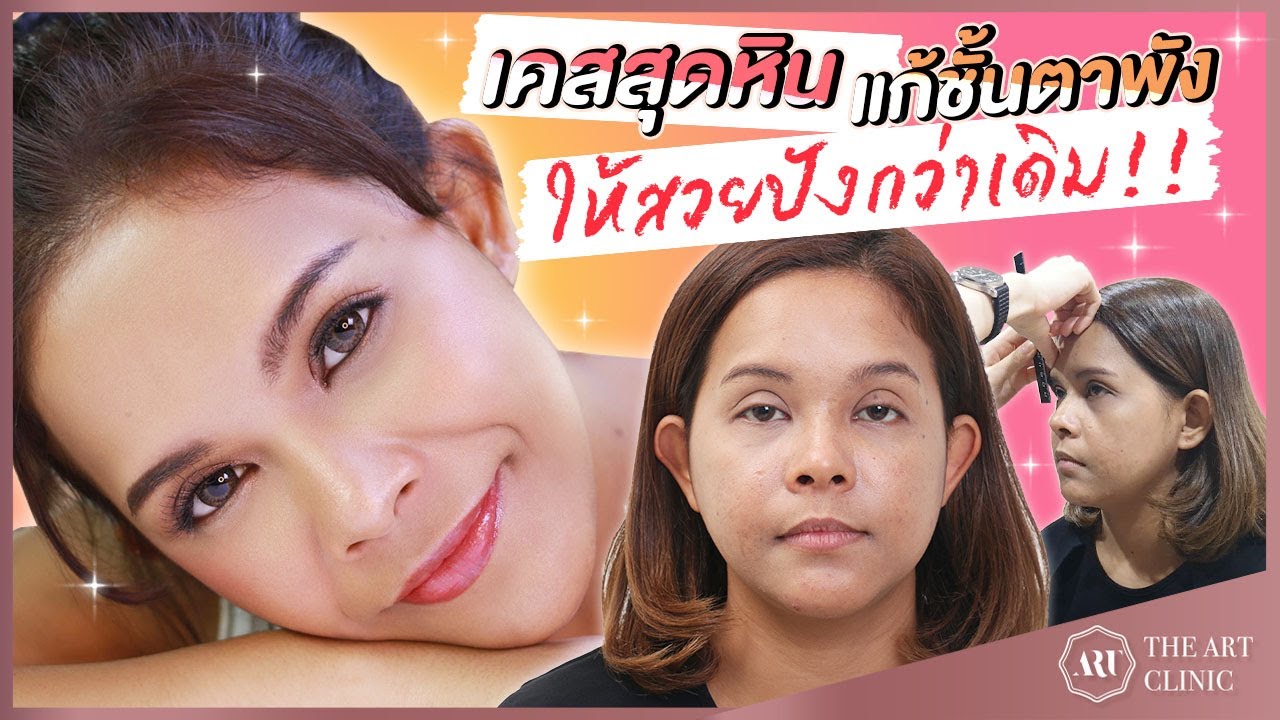 รีวิวแก้ตา : เคสยาก ตาปรือ ตาหนา กล้ามเนื้อตาอ่อนแรง 5 เดือนผ่านไปสุดปัง