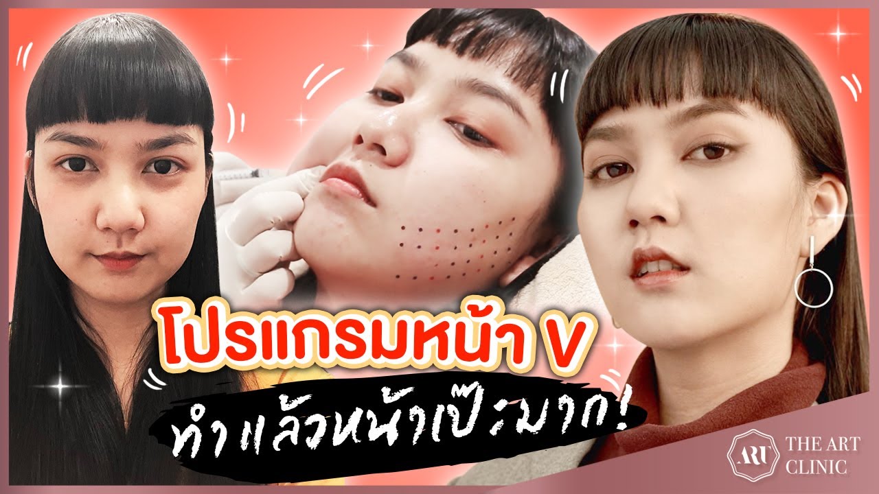 HIFU x Meso Fat : โปรแกรมคู่จิ้น ที่ทำออกมาแล้วหน้าเป๊ะมาก!