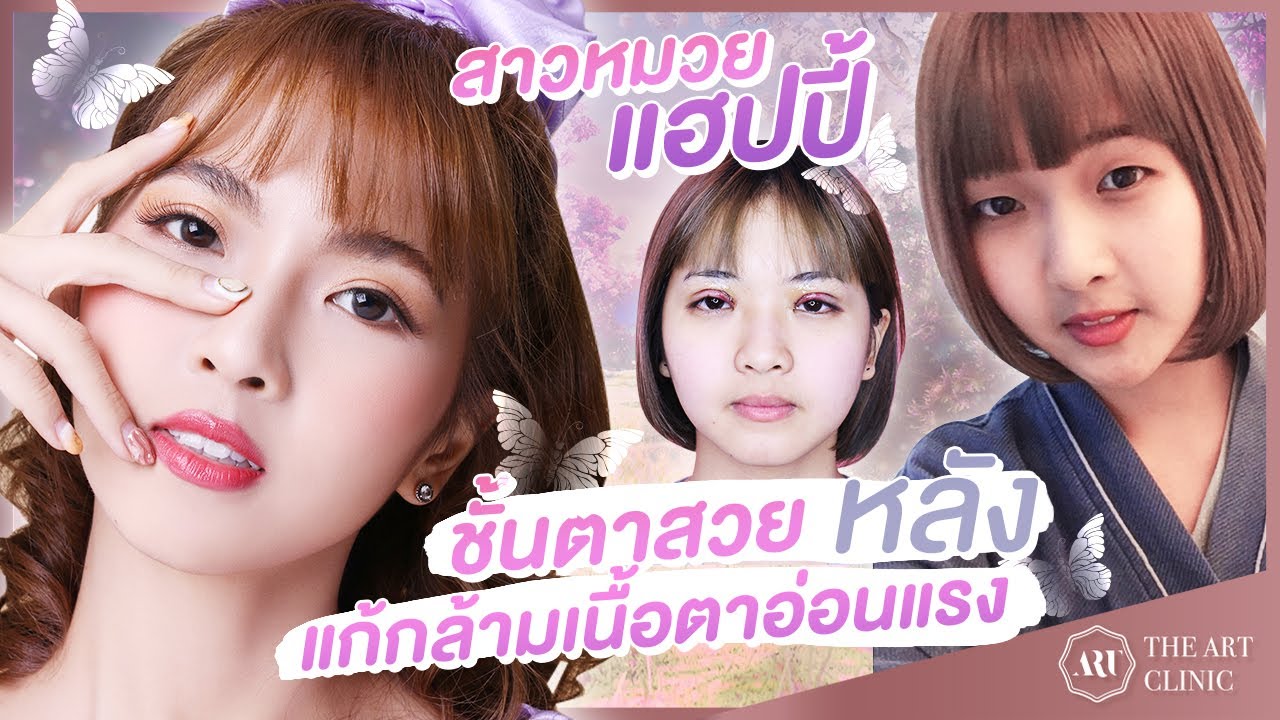 รีวิวตา 2 ชั้น : เปลี่ยนตาซึมเศร้า ให้สวยแบ๊วเหมือนสาวเกาหลี