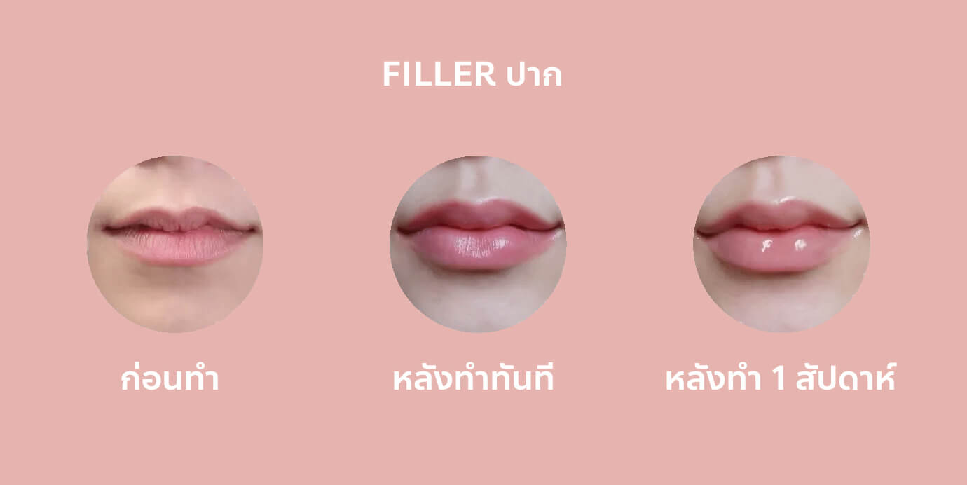 Filler-Mouth-01