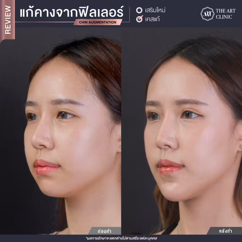 แก้คางจากสารเติมเต็ม