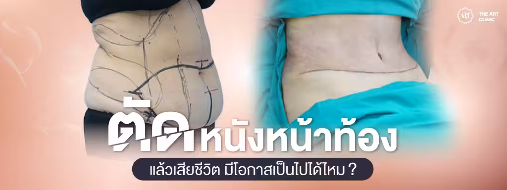 ตัดหนังหน้าท้อง แล้วเสียชีวิต มีโอกาสเป็นไปได้ไหม