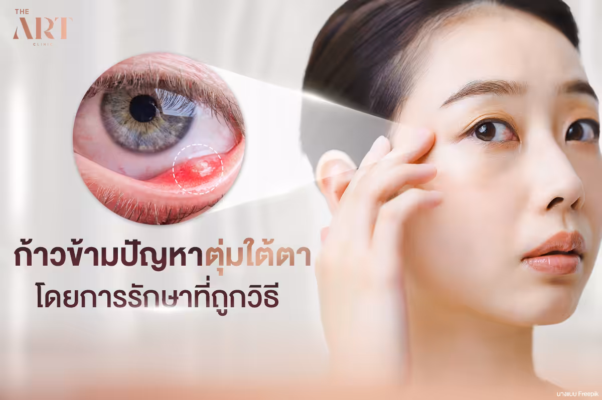 ตุ่มใต้ตา--ความเข้าใจและการจัดการกับปัญหาผิวที่ไม่คาดคิด-