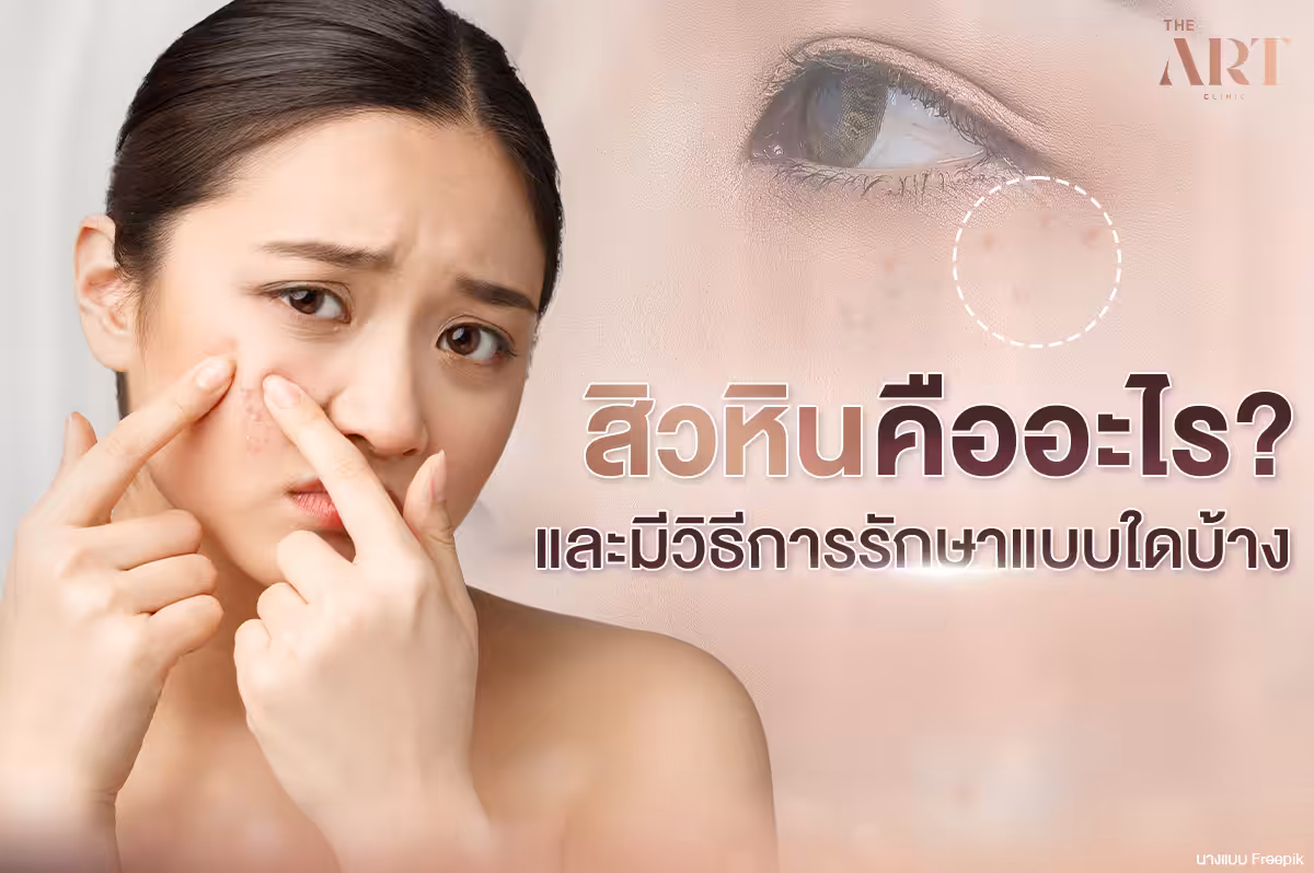 ทำความเข้าใจปัญหาสิวหิน: สาเหตุ, การรักษา, และการดูแล