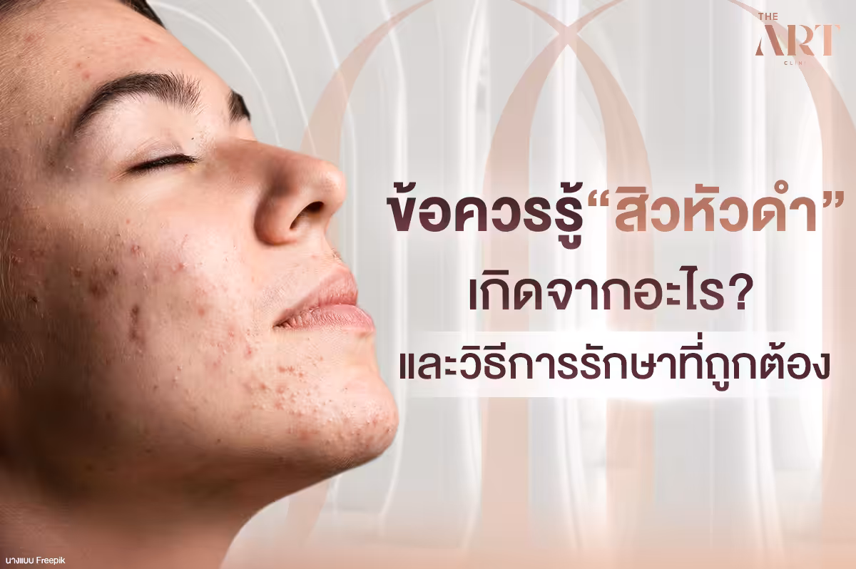 สิวหัวดำ--ปัญหาผิวที่ใครๆ-ก็ไม่อยากเจอ