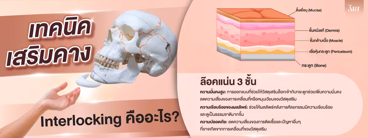 เทคนิค-เสริมคาง-Interlocking-คือ