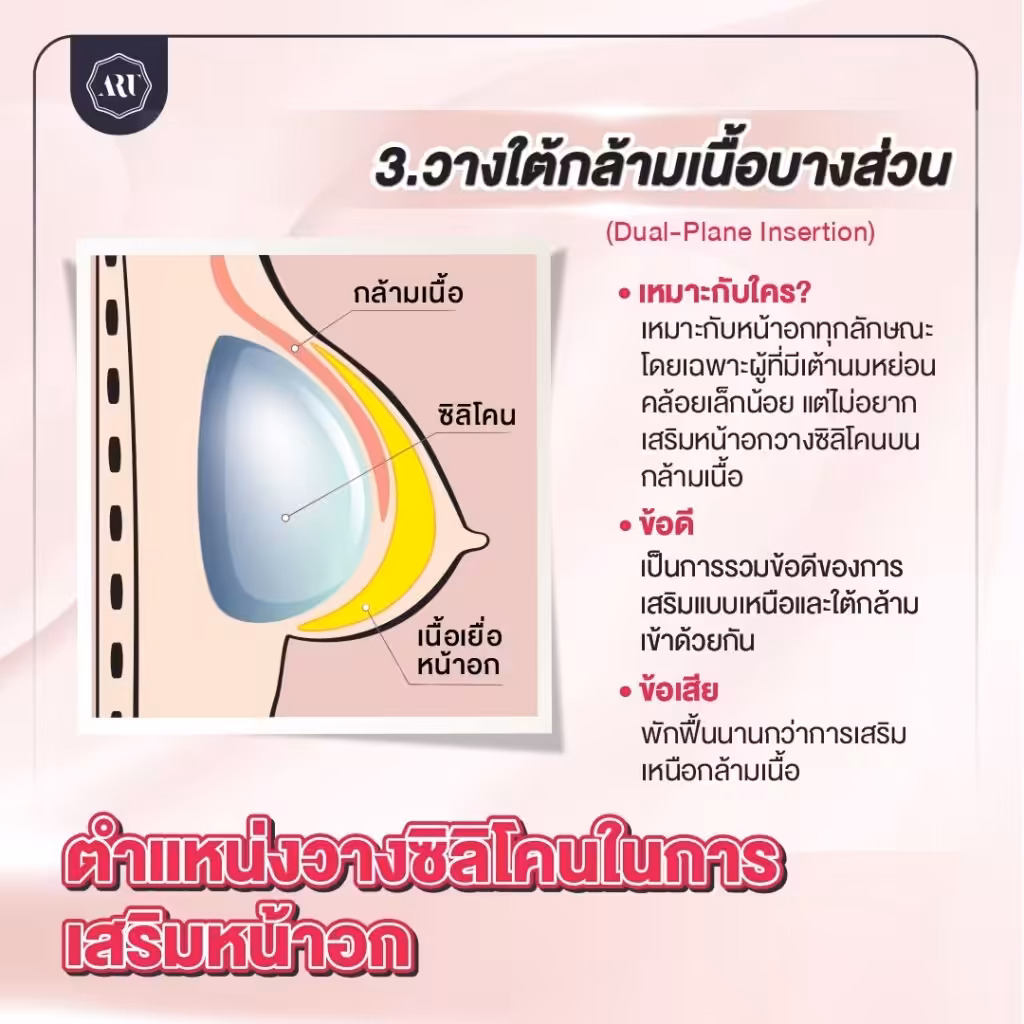 วางใต้กล้ามเนื้อบางส่วน