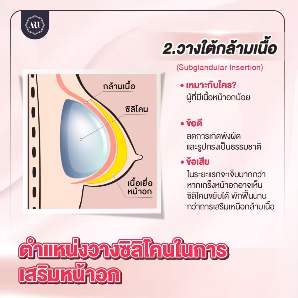วางใต้กล้ามเนื้อ
