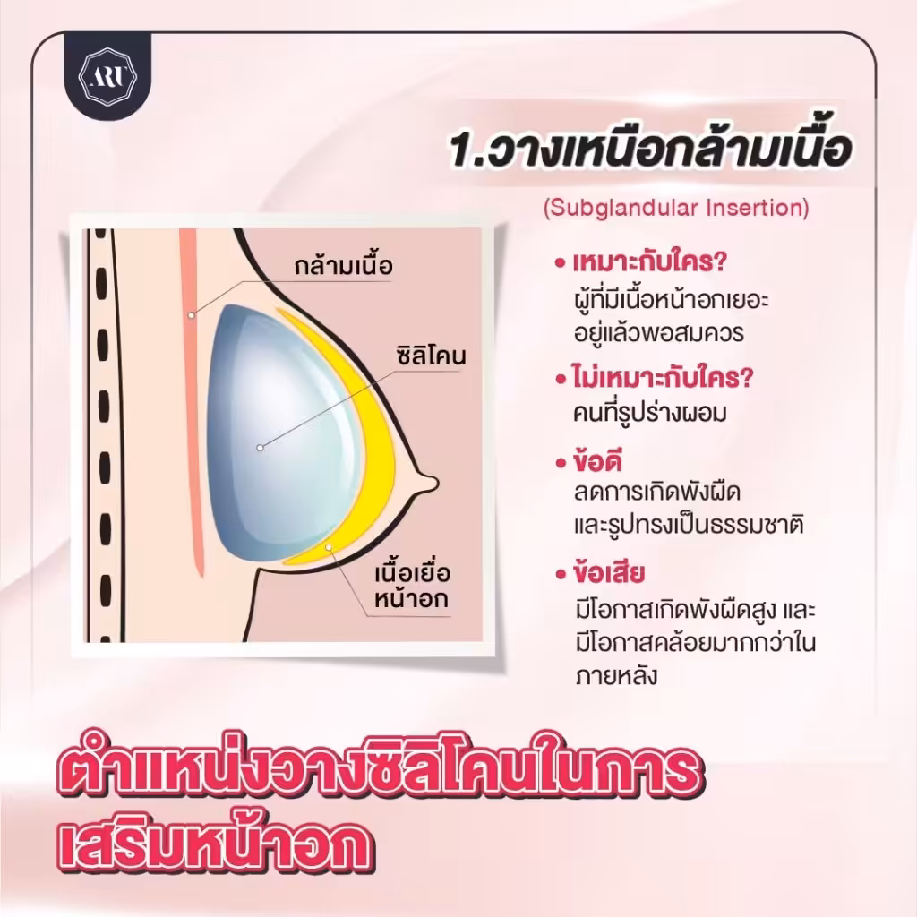 วางเหนือกล้ามเนื้อ