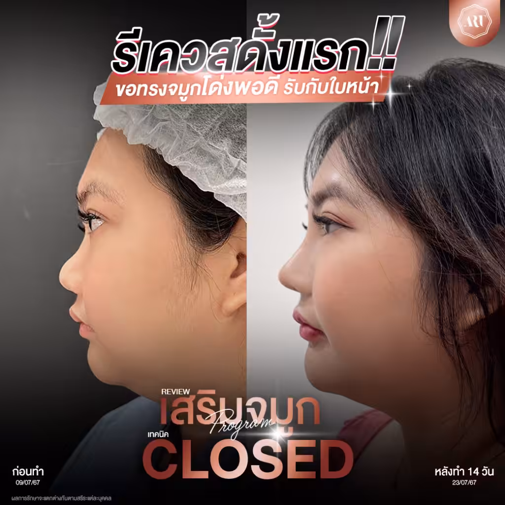 แก้จมูก closed