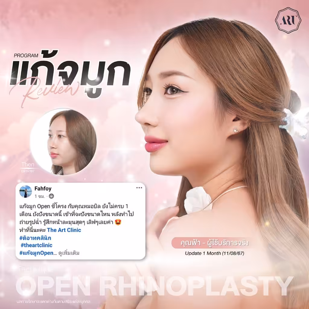 แก้จมูก open