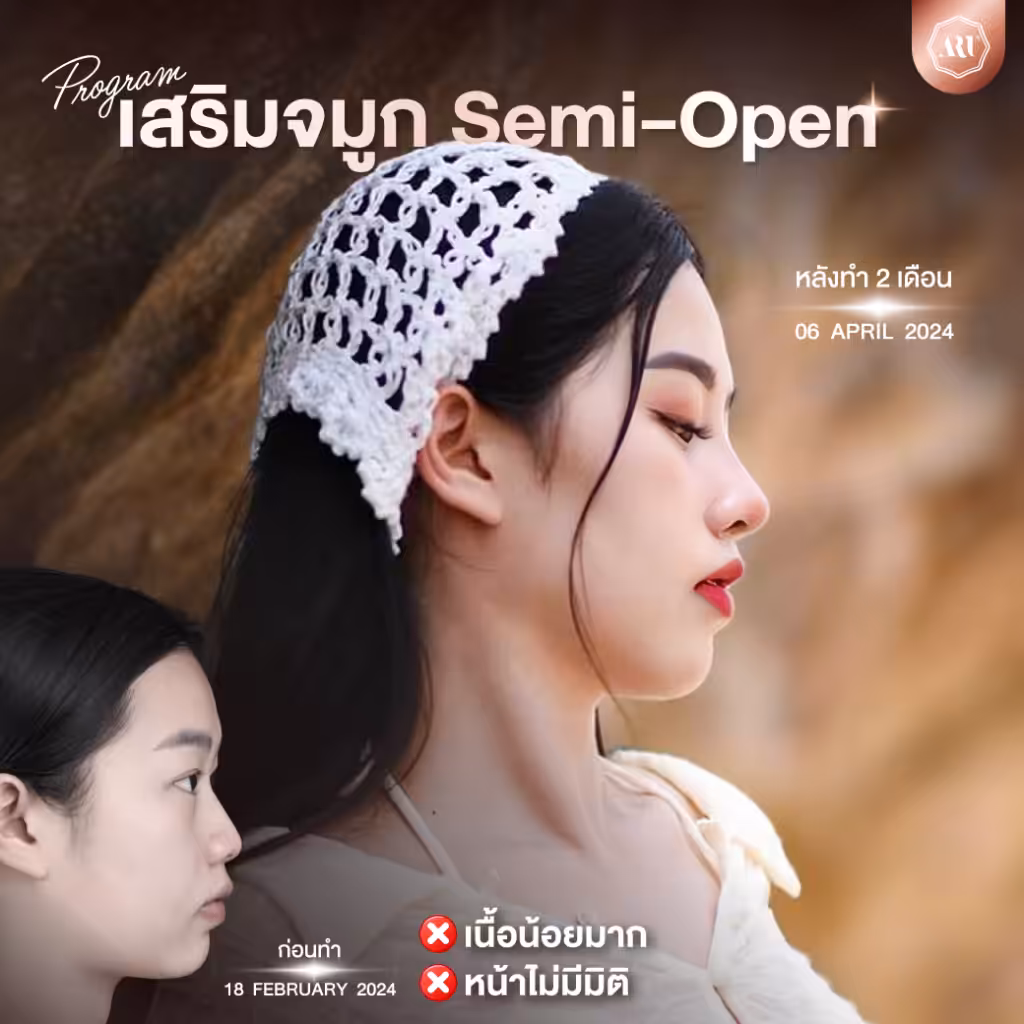 แก้จมูก semi open