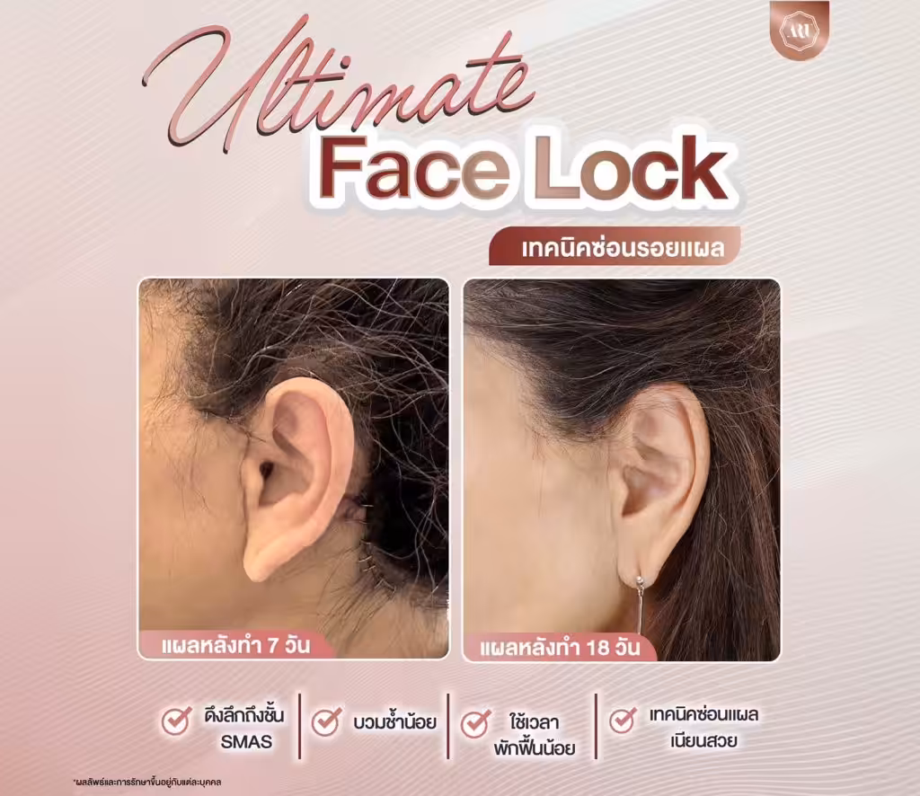ขั้นตอนการดึงหน้า ด้วยเทคนิค ultimate facelock 