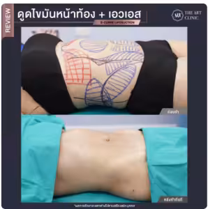 ดูดไขมันเอว