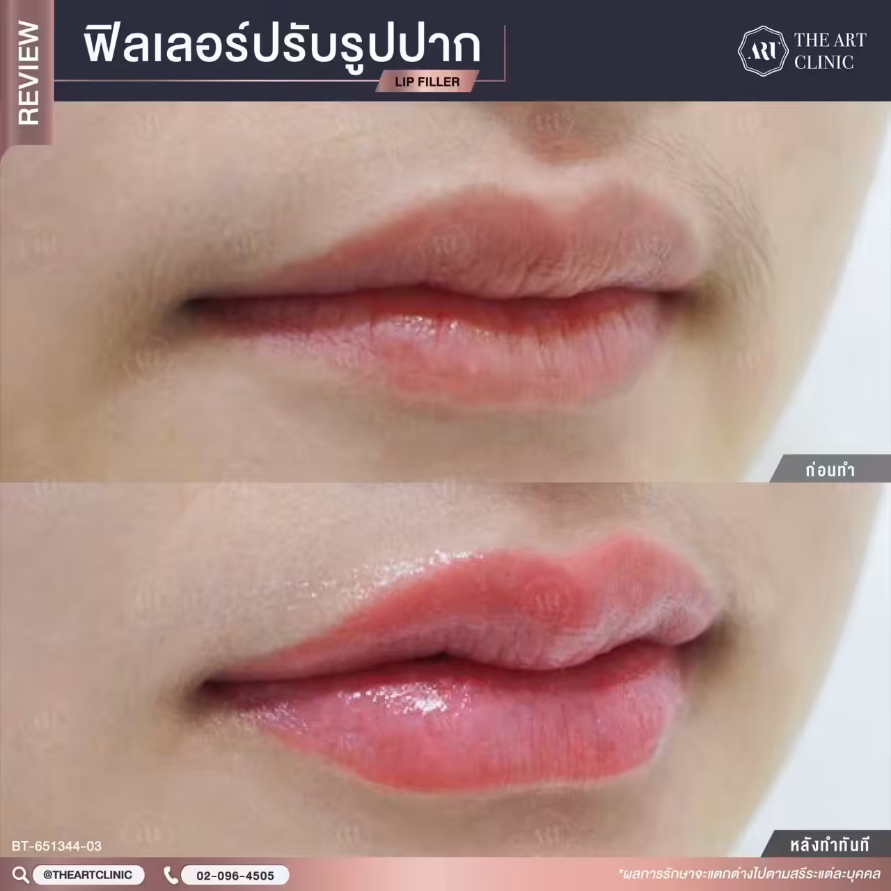 เติมฟิลเลอร์