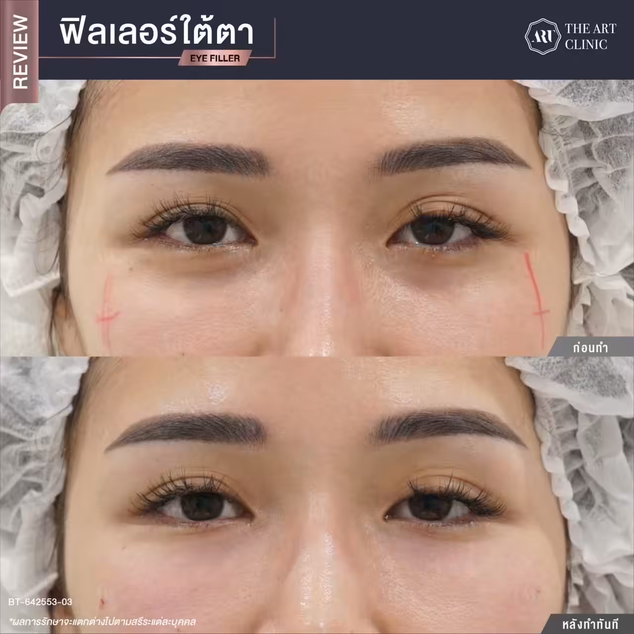 หลังฉีดฟิลเลอร์ใต้ตาทันที