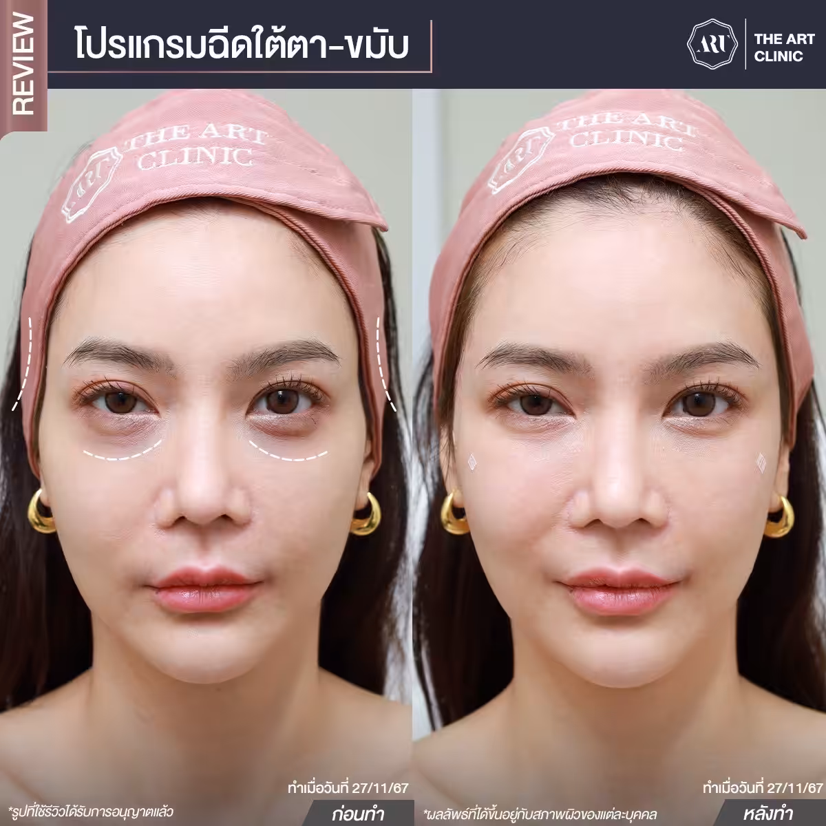 หลังฉีดฟิลเลอร์