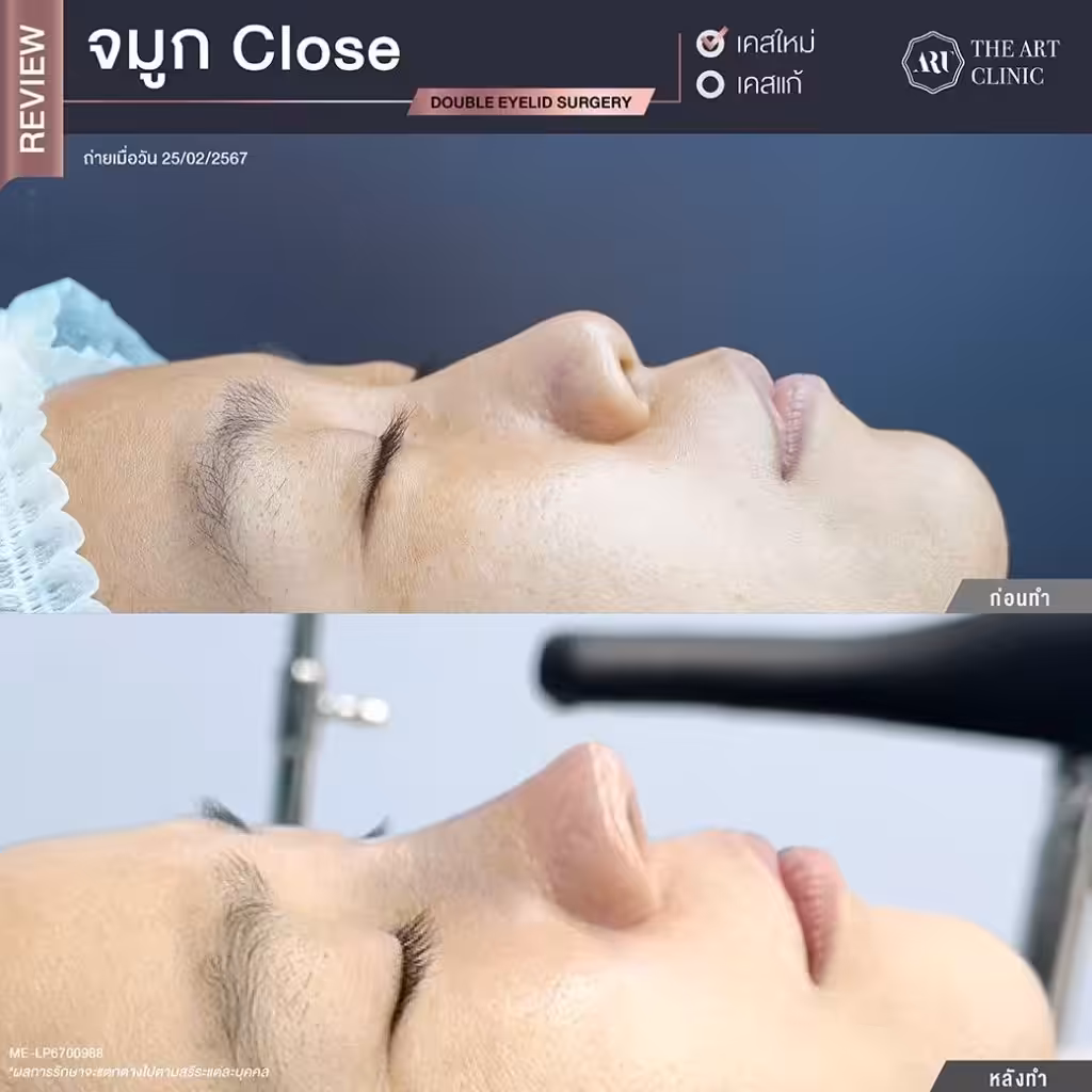 รีวิวเสริมจมูกเทคนิค Closed