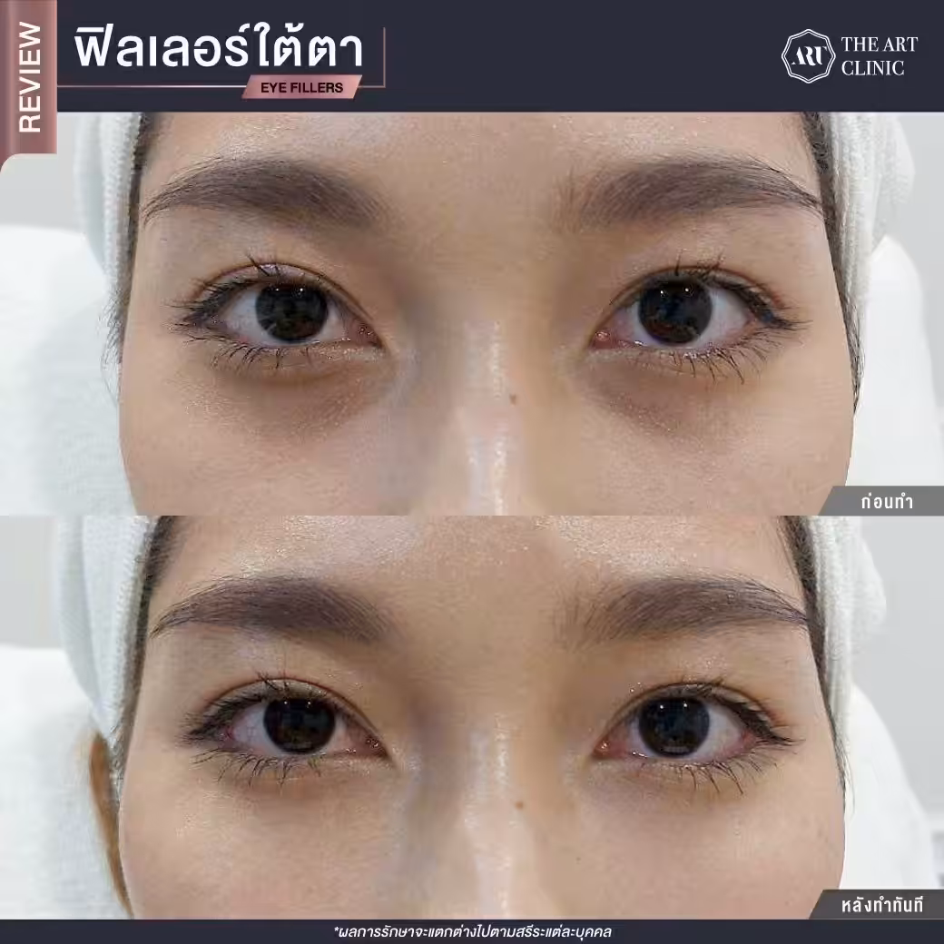 ใต้ตาคล้ำโทรม