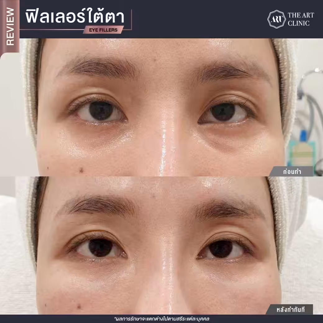 ฟิลเลอร์ถุงใต้ตา