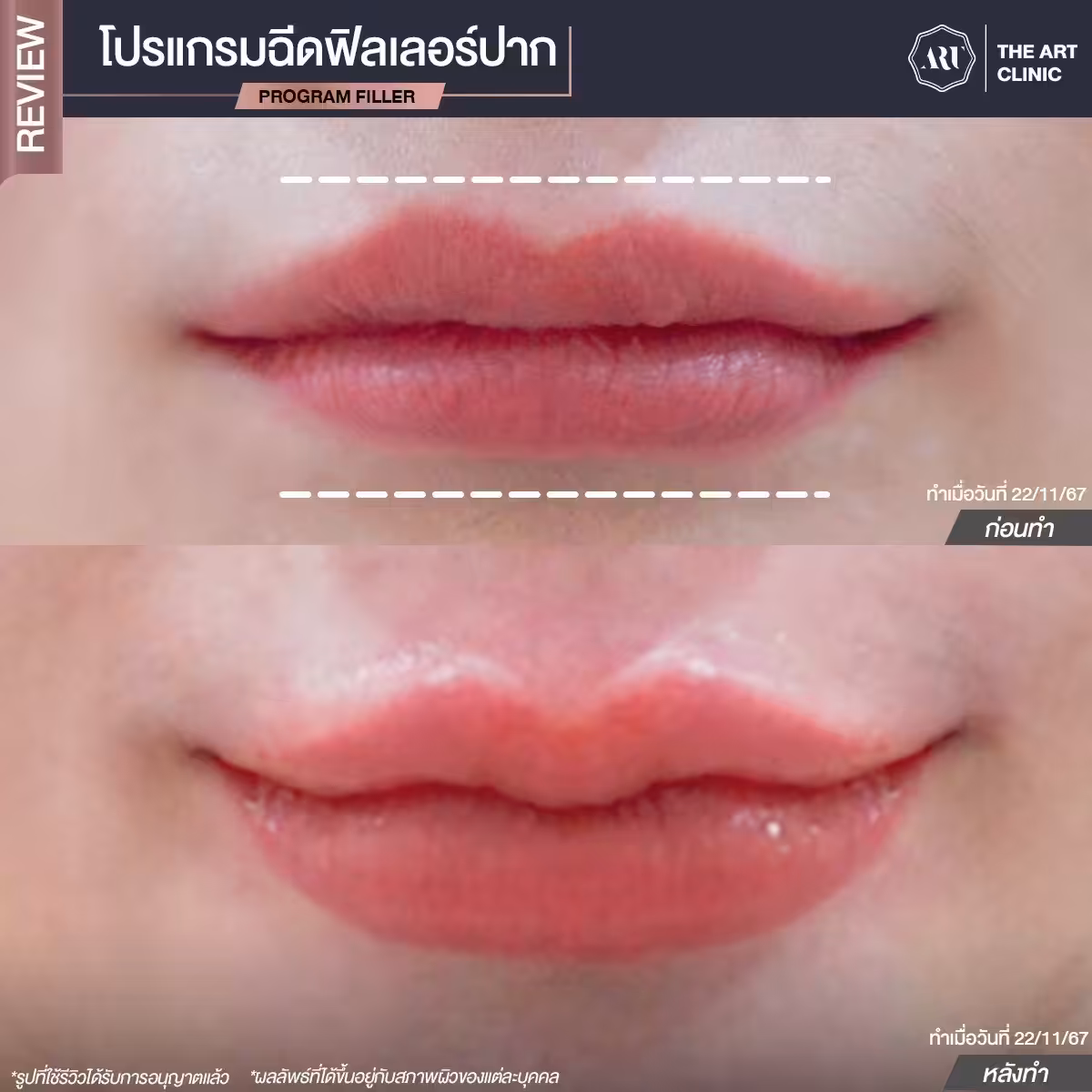ฉีด filler
