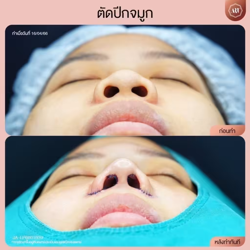 ตัดปีกจมูกราคาเท่าไหร่