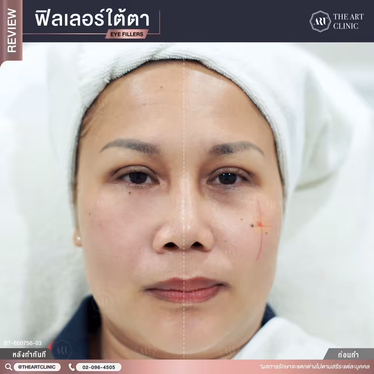 หลังฉีดใต้ตาทันที