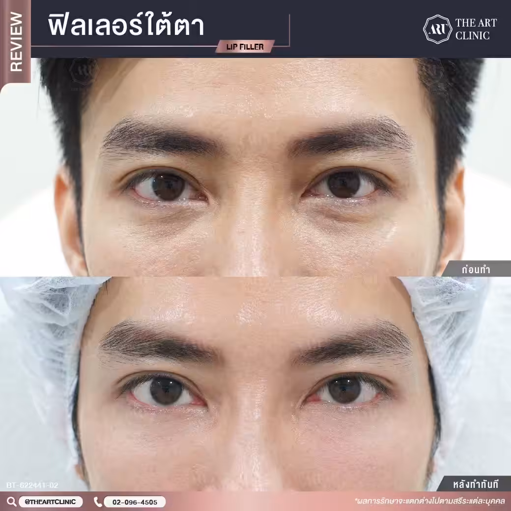 ฟิลเลอร์ใต้ตาผู้ชาย