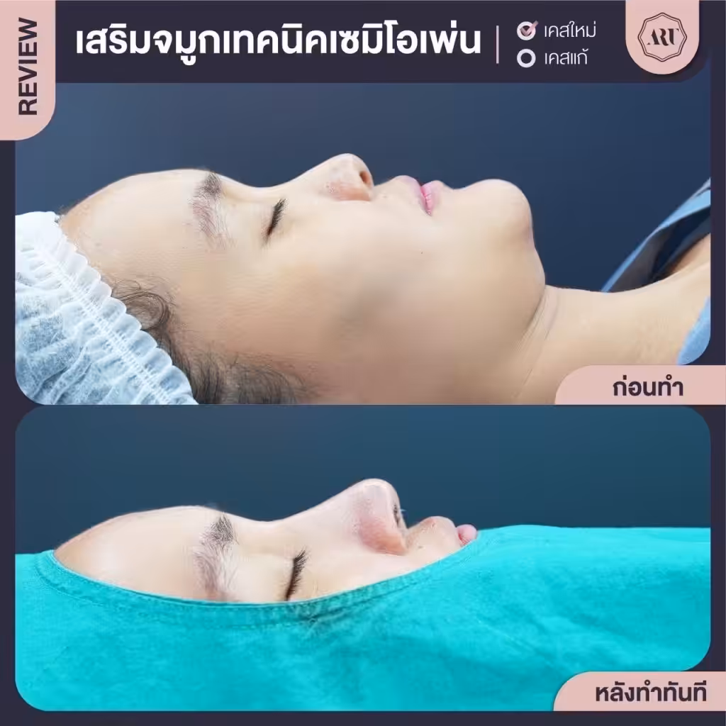คลินิกเสริมจมูก